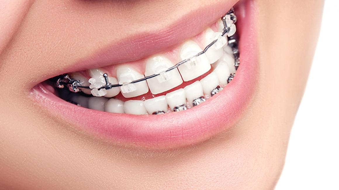 Ortodonti Tedavi Nedir?