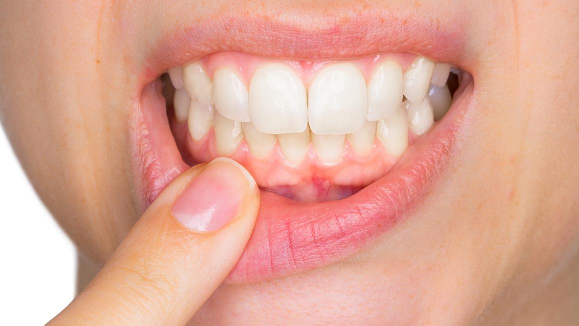 Diş Eti Hastalıkları Tanı ve Tedavileri