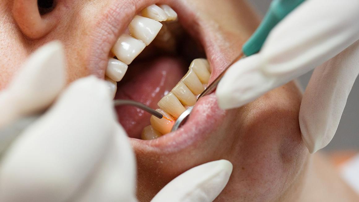 Diş Hekimliğinde Lazerli Uygulamalar