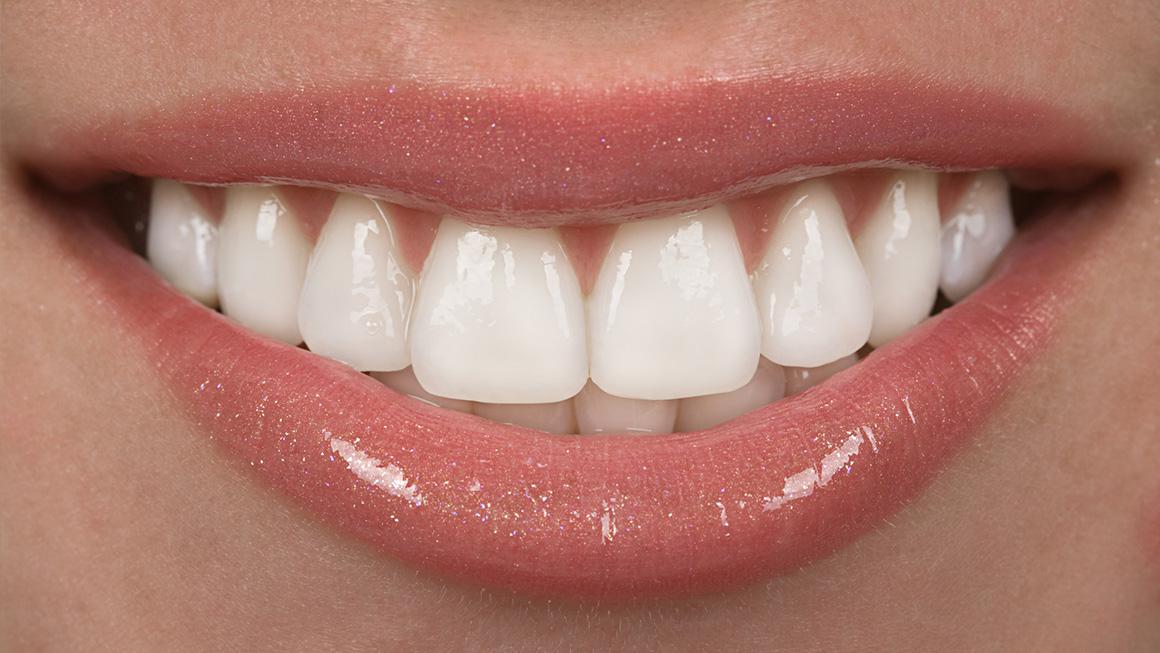Gummy Smile Treatment