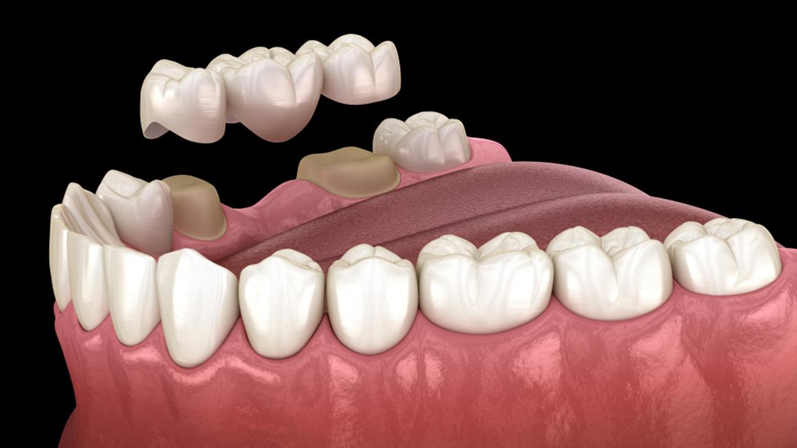 Dental Bridge Procedure